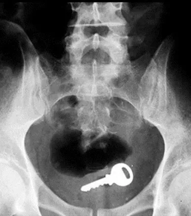 24 Gegenstände, die im Rektum von Patienten gefunden wurden