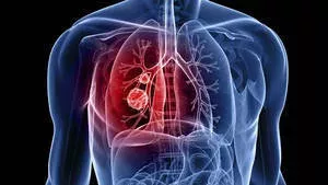Lungenkrebs: Definition, Ursachen, Diagnose, Symptome und Anzeichen, Therapie und Behandlung, um was handelt es sich?