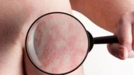 Schuppenflechte (Psoriasis): auf der Kopfhaut/Hand, Behandlung, Ernährung, Hausmittel und Symptome