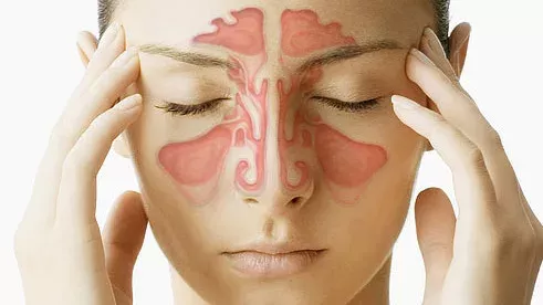 Sinusitis: Definition, Ethmoidalis/ Maxillaris/ Frontalis, Symptome, Hausmittel, Behandlung