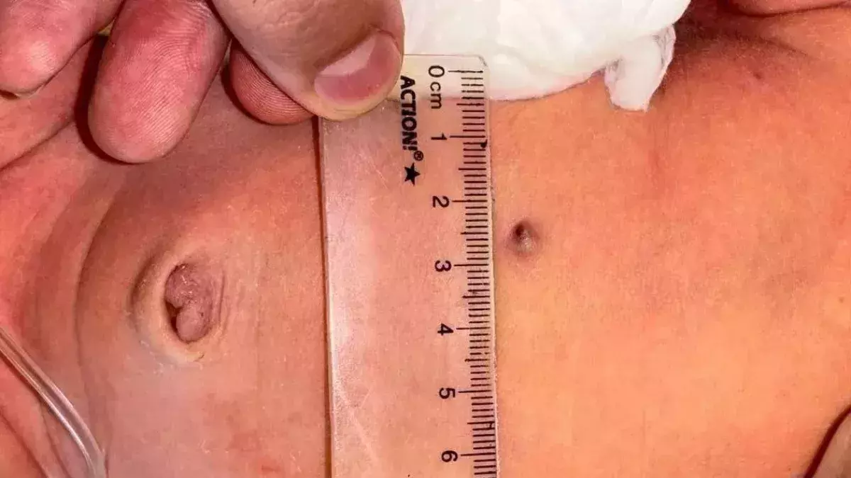 Das Baby wurde im Mutterleib angeschossen.