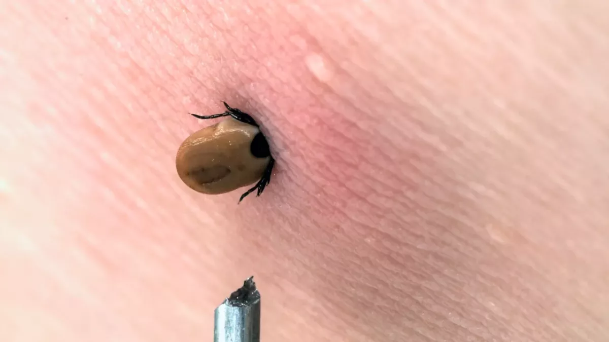 Zeckenbiss: Was tun?
