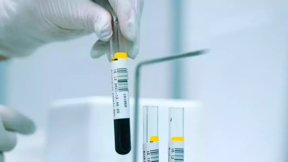 Ist die Behandlung mit Nabelschnurblut die Lösung im Kampf gegen HIV?
